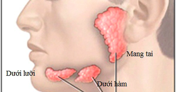Vôi hóa tuyến nước bọt