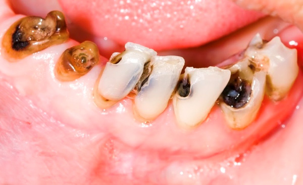 Sâu răng