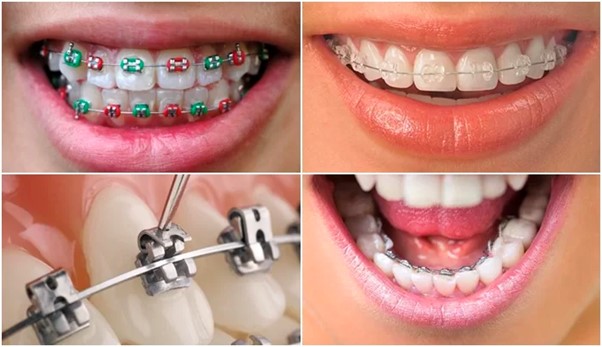 Niềng răng mắc cài kim loại là loại tốt nhất