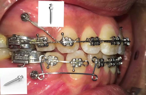 Cắm vít niềng răng