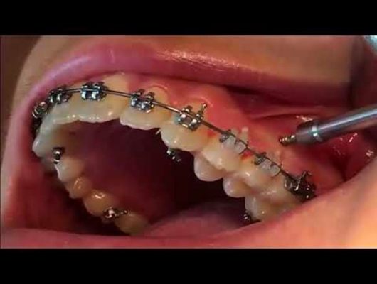 Quy trình cắm vít niềng răng