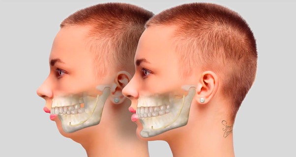 Phương pháp chỉnh răng hô không cần niềng hiệu quả, an toàn