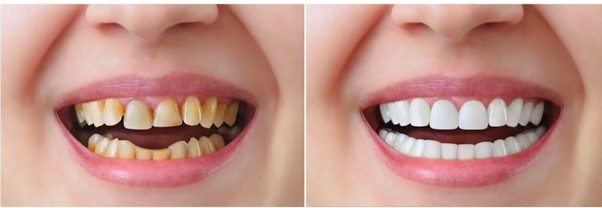 Các phương pháp chỉnh răng hô không niềng Các phương pháp chỉnh răng hô không niềng