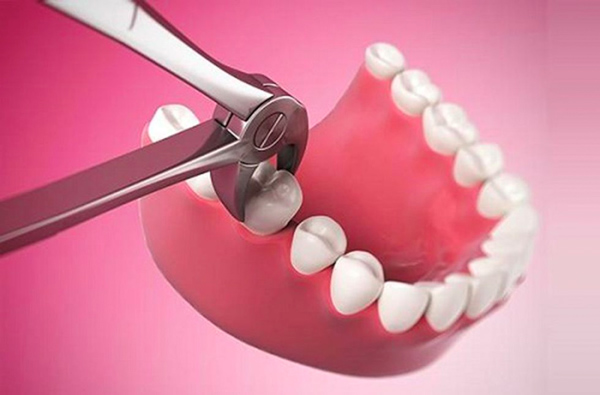 Có nên nhổ răng ngày đèn đỏ? Những điều cần lưu ý và hạn chế