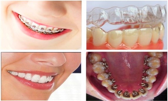 Niềng răng là một phương pháp chỉnh nha thẩm mỹ