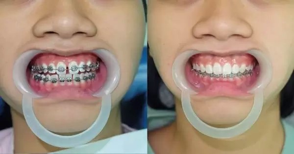 Ưu điểm của việc niềng răng