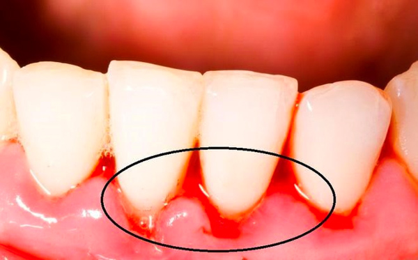 Chảy máu chân răng có thể là dấu hiệu của nhiều vấn đề khác nhau về sức khỏe