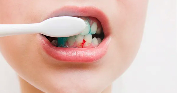 Đánh răng bị chảy máu do đâu? Chảy máu chân răng khi đánh răng có nguy hiểm?