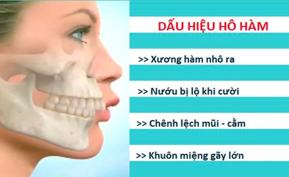 Biểu hiện của hô hàm