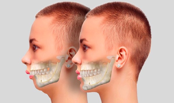 Hô hàm có niềng răng được không? Giải pháp nào tốt?