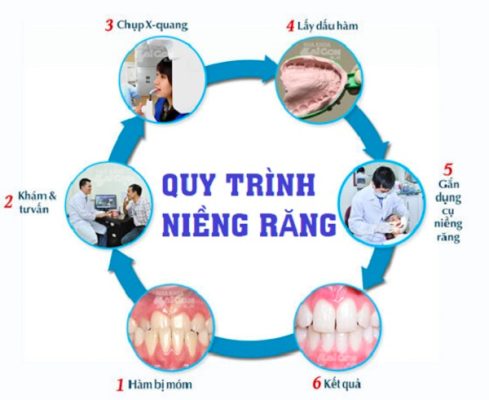 Quy trình niềng răng chuẩn nha khoa