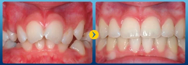 Niềng răng giúp sở hữu nụ cười đều đẹp