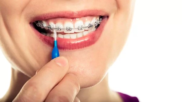 Giá cả của việc niềng răng 1 hàm Giá cả của việc niềng răng 1 hàm