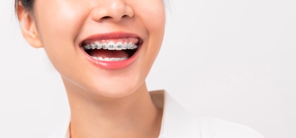 Thời gian niềng răng 1 hàm có thể dao động từ 12 đến 24 tháng Thời gian niềng răng 1 hàm có thể dao động từ 12 đến 24 tháng