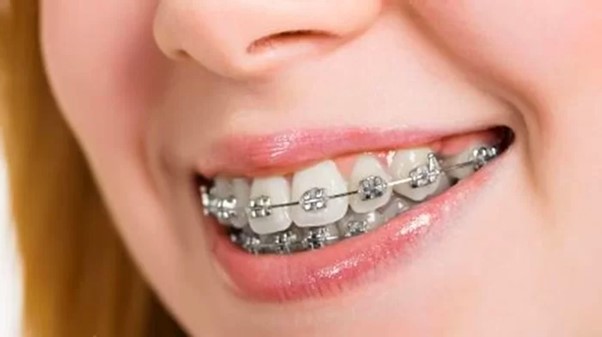 Niềng răng hô là gì? Ưu và nhược điểm? Thời gian niềng răng hô bao lâu