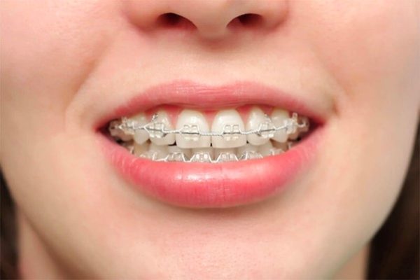 5 bước trong quy trình niềng răng hô tại Đức Hạnh Dental Lab