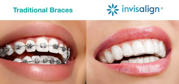 Niềng răng Invisalign là phương pháp điều trị chỉnh nha sử dụng các khay trong suốt