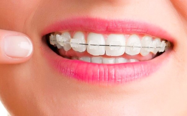 Niềng răng mắc cài sứ giá bao nhiêu?