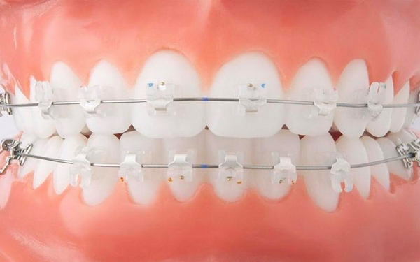 Chi phí niềng răng mắc cài trong suốt từ 40 triệu đến 45 triệu/ hàm