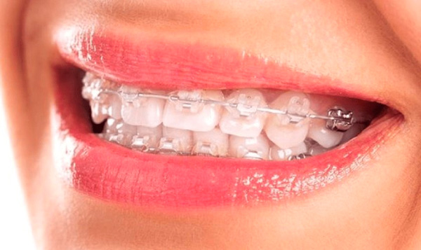 Niềng răng mắc cài trong suốt là gì? có tốt không?