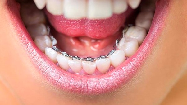 Phương pháp niềng răng mặt trong vẫn còn nhiều hạn chế