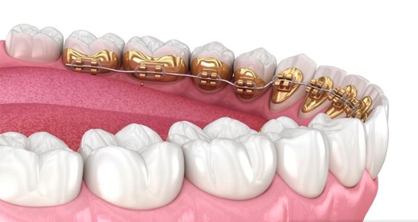 Giá thành của niềng răng mặt trong