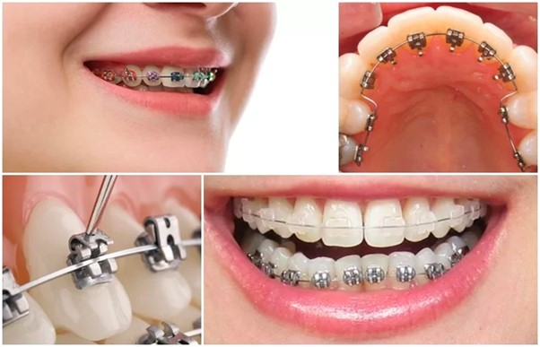 Niềng răng rẻ nhất bao nhiêu tiền? Bảng giá mới nhất 2024