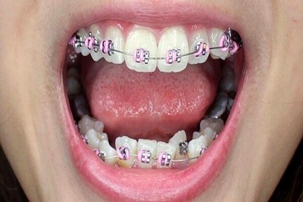 Chi phí để niềng răng hô ở mỗi người có thể thay đổi do sự khác biệt