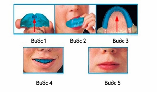 Các bước niềng răng tại nhà