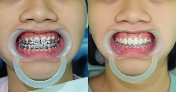 Niềng răng giúp khắc phục tình trạng răng thưa