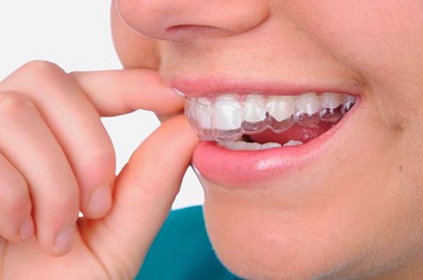 Niềng răng trong suốt Clear Correct