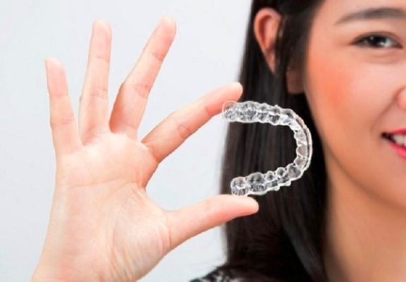 Niềng răng trong suốt mất khoảng từ 9 – 18 tháng