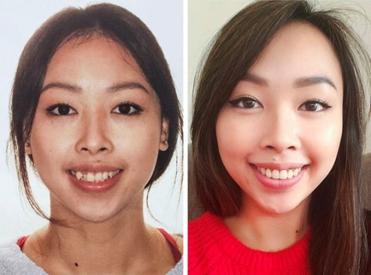 Trước và sau khi niềng răng ảnh hưởng tới khuôn mặt như thế nào?