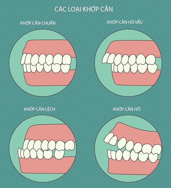 Hình ảnh trước và sau khi niềng răng có khớp cắn hở