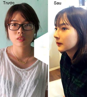 Góc nghiêng thay đổi sau khi niềng răng