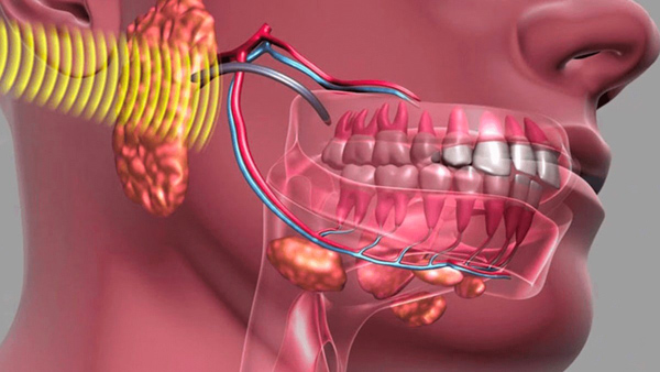 Giai đoạn và biểu hiện phổ biến của khối u xương hàm