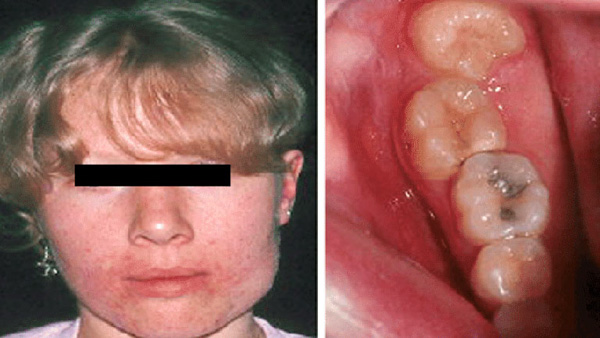 Các biến chứng khi bị u men xương hàm